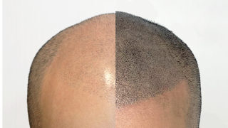 Scalp Micropigmentation hair loss treatment at Hong Kong beauty salon OJO de Bella