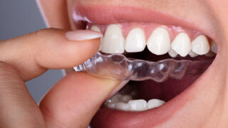 Mouthguard - treatment for teeth grinding and sleep bruxism