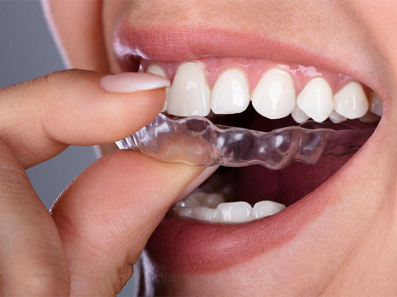 mouthguard - treatment for prevention of teeth grinding and bruxism