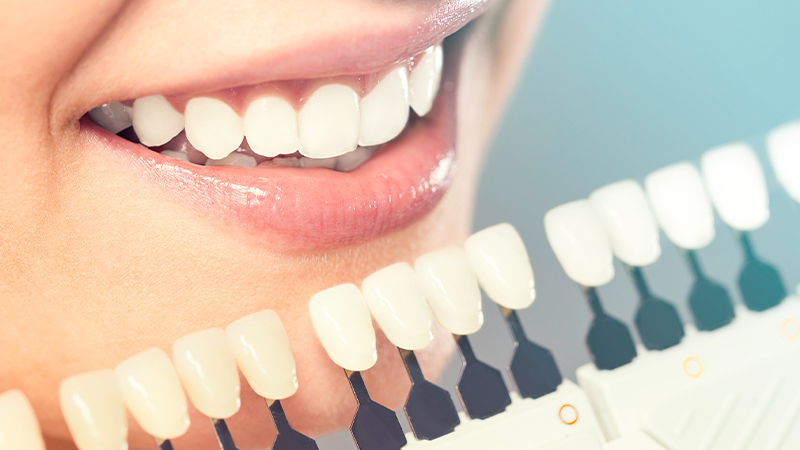Cosmetic dentistry - teeth whitening, porcelain veneers, implants